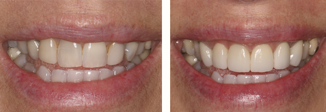 before and after photo with crowns and venners