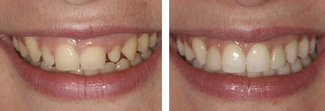 before and after photo comp venner smile