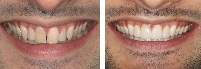 before and after picture with dental veneers