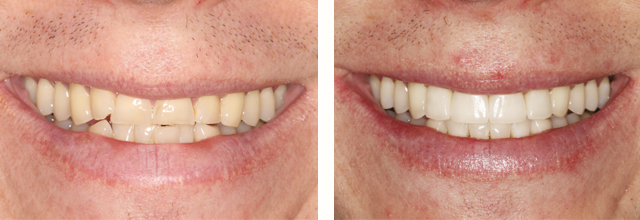 Before and after dental work done in Needham MA