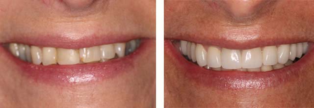 smile before and after dental full mouth rehab
