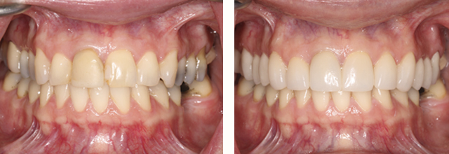 picture of full mouth dental work rehab