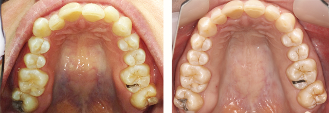 upper arch before and after invisalign 