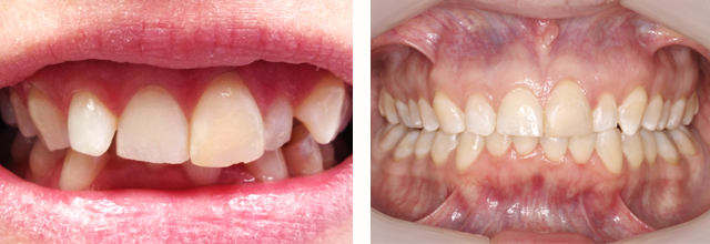 before and after smile with invisalign