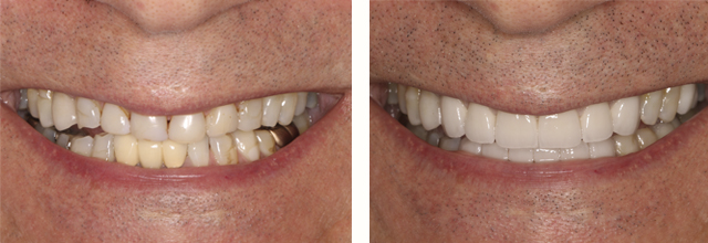 Before and after smile Elizabeth Russ Dental