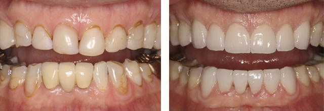Elizabeth Russ Dental Needham teeth picture before and after