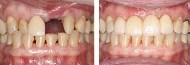 Before and after dental work with bridge and crown