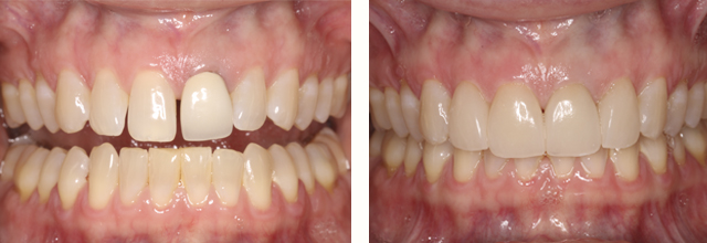 Cosmetic Needham dentist befor and after picture