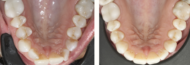 Needham Dentist before and after photos of lower arch after ortho