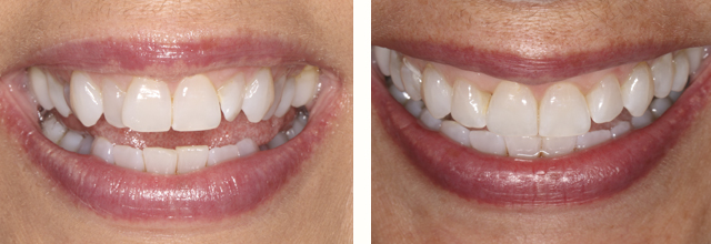 Dentist office in Needham smile before and after ortho
